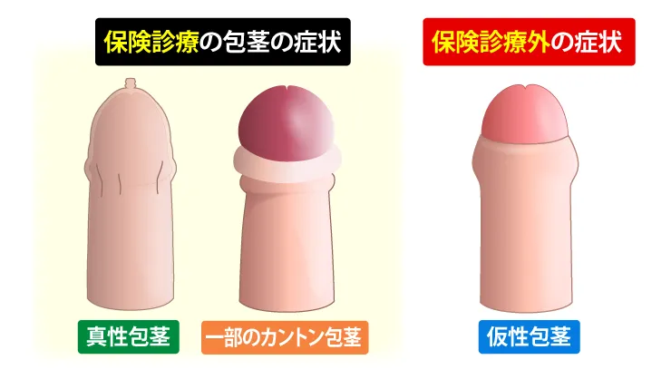 保険診療の包茎の症状と保険診療外の包茎の症状