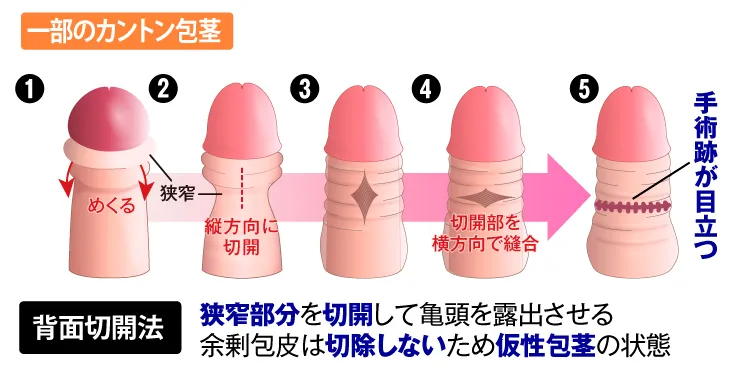 保険診療:背面切開法 カントン包茎