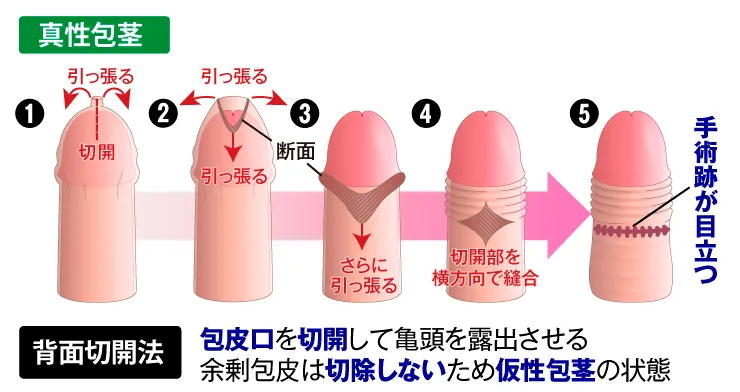 保険診療:背面切開法 真性包茎