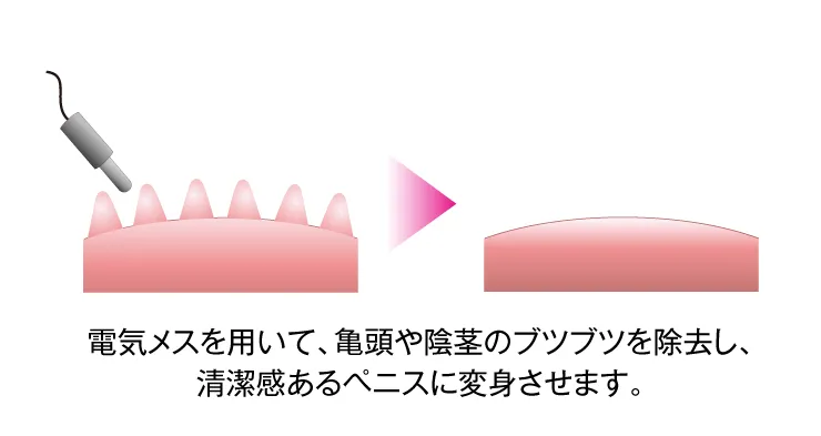 MSクリニックのブツブツの治療