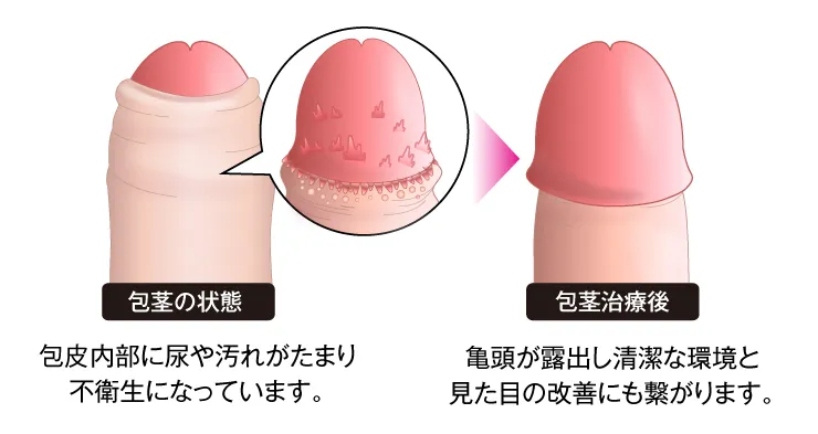 包茎手術でブツブツの治療