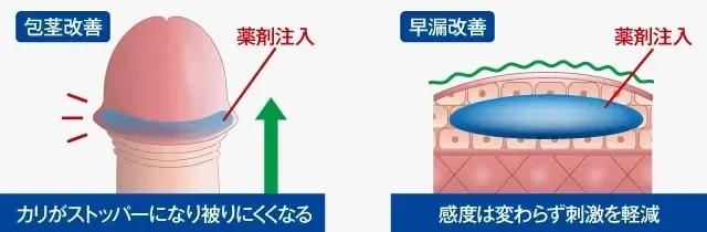 包茎・早漏改善Wの効果