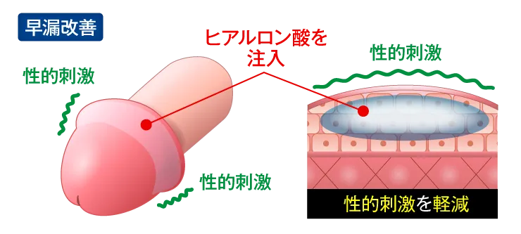 嵌頓包茎(かんとんほうけい)は無理に皮を剥かない