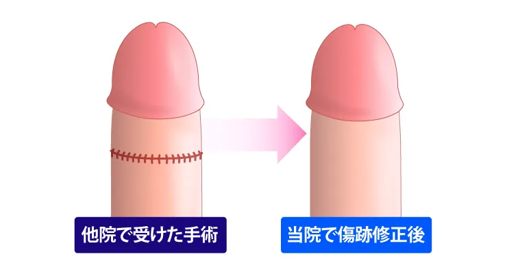 傷跡修正のイラスト