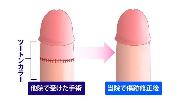ツートンカラー修正のイラスト