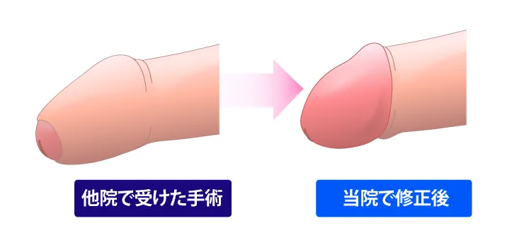 包皮がまだ被ってくるのイメージイラスト