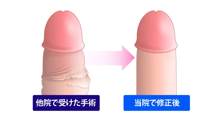 異物除去のイラスト