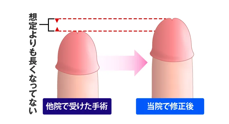 長茎術の長さ出しイラスト