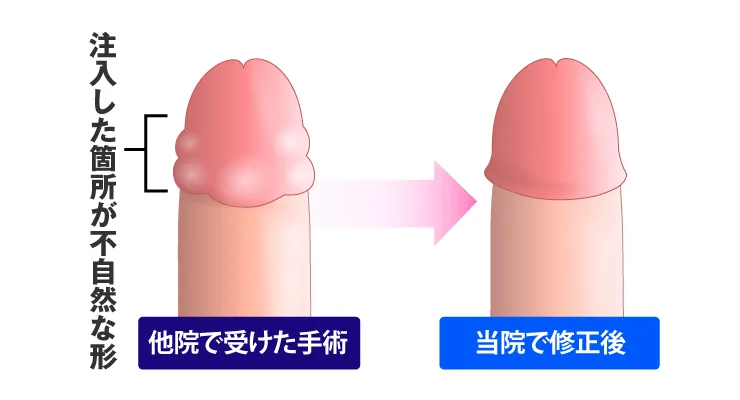 亀頭増大術の凸凹修正イラスト