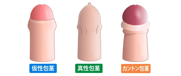 ❷包茎性早漏